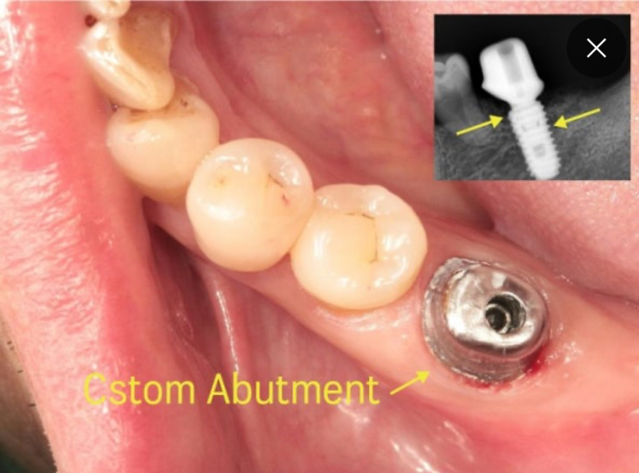 Custom Abutment